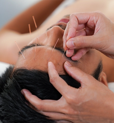A man having facial acupuncture