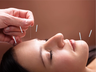 Someone getting facial acupuncture